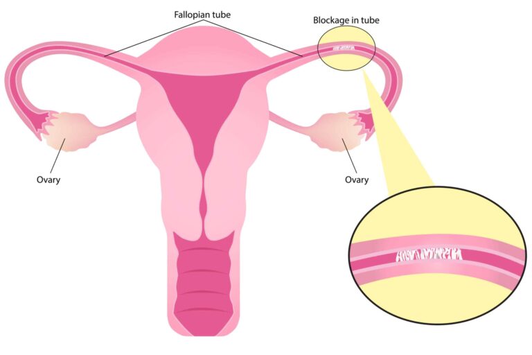 Blocked Fallopian Tubes: Causes, Treatment, and Complications