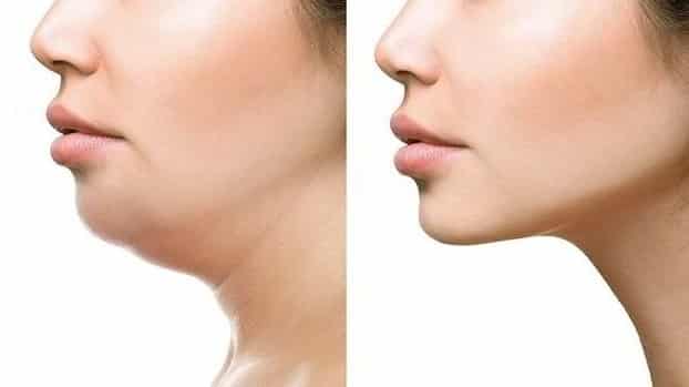 An Extensive Guide to Remove Double Chin Fat Naturally at Home